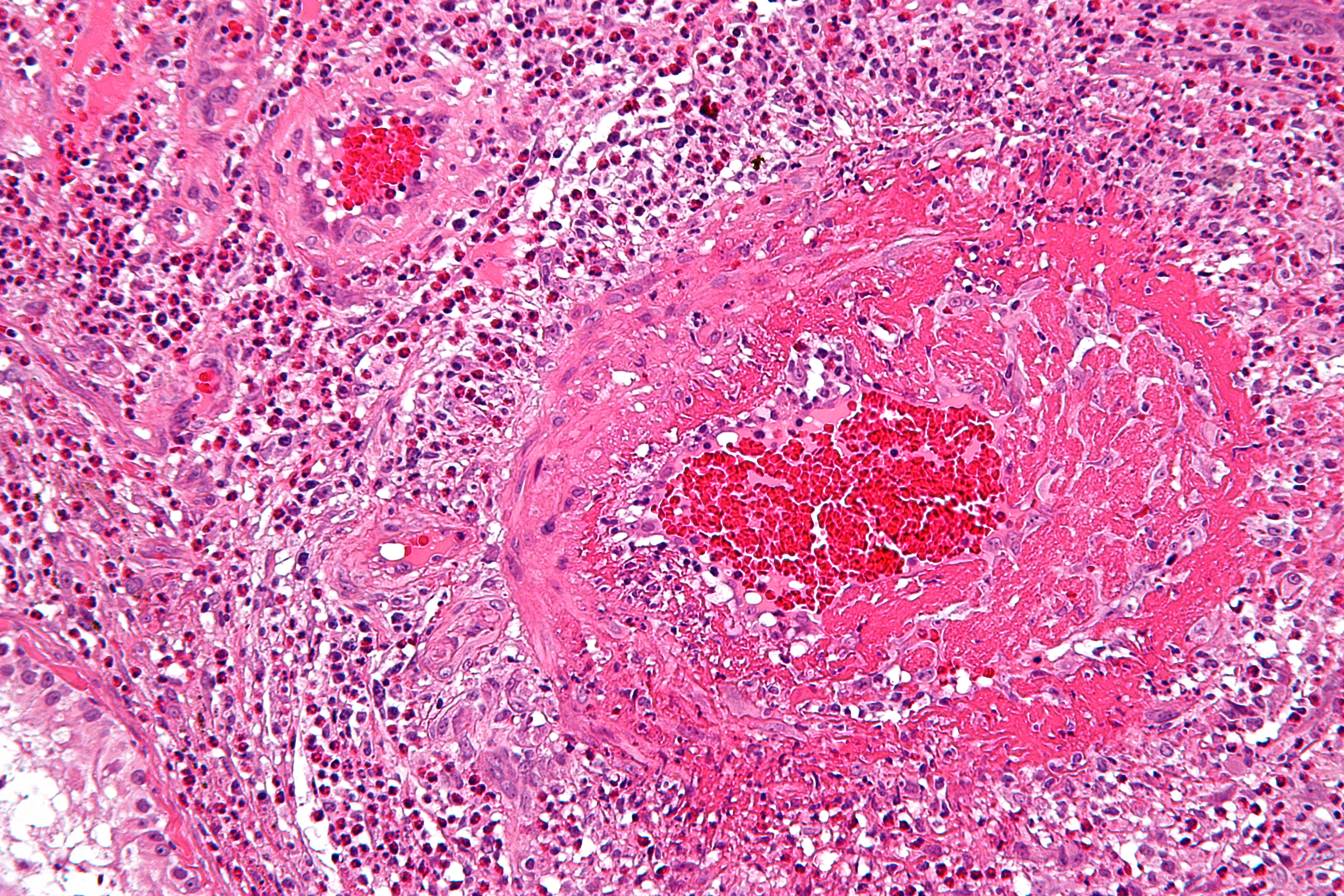 Danno da vasculite eosinofilica al microscopio, consistente con la sindrome di Churg-Strauss